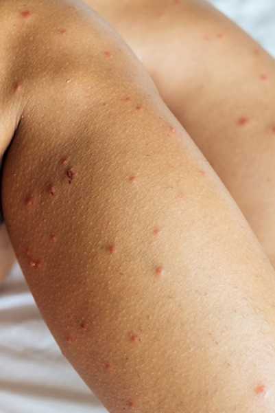 Legs showing bed bug bites